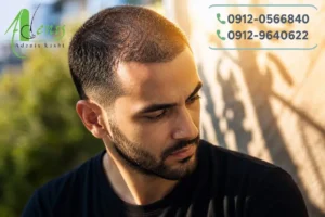 تعریق بعد از کاشت مو در هوای گرم