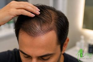 ترمیم فولیکول‌های کاشته شده بعد از کاشت مو