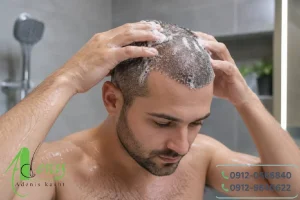 شستشوی سر بعد از کاشت مو برای کاهش شوره