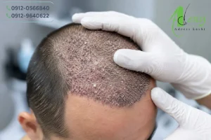 پوسته سر بعد از کاشت مو