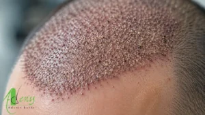 بررسی پوسته های سر بعد از کاشت مو