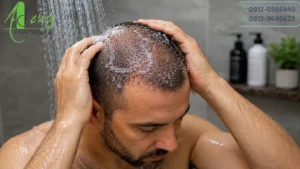 شستشوی صحیح پوسته های سر بعد از کاشت مو