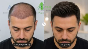 طبیعی شدن خواب مو با رشد موها