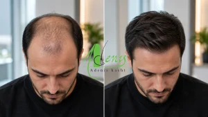 نتیجه کاشت مو برای درمان طاسی سر قبل و بعد از کاشت