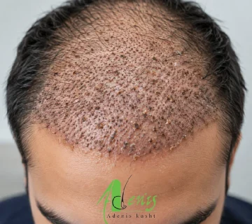 دلمه بعد از کاشت مو روی پوست سر در روزهای ابتدایی