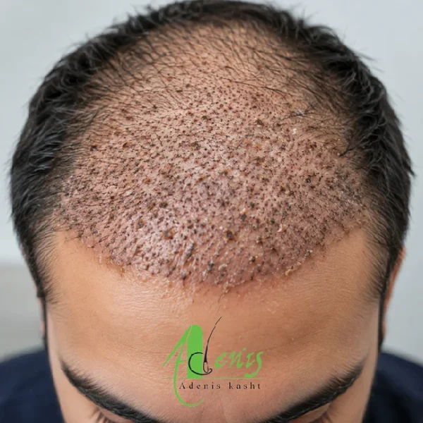 دلمه بعد از کاشت مو روی پوست سر در روزهای ابتدایی